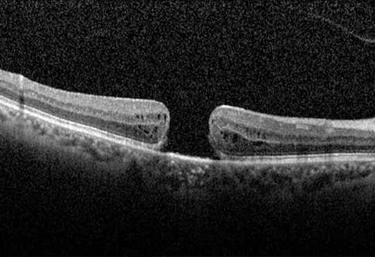 retinosis pigmentaria