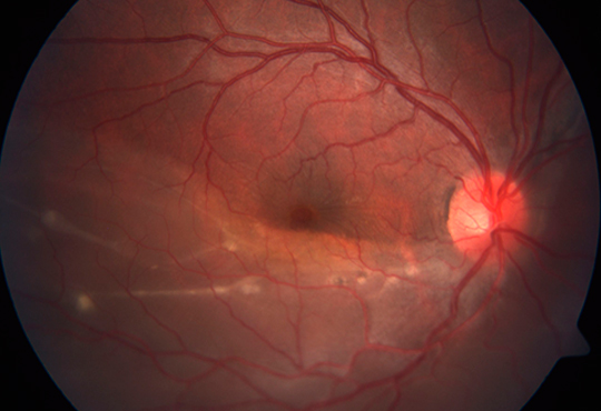 desprendimineto retina