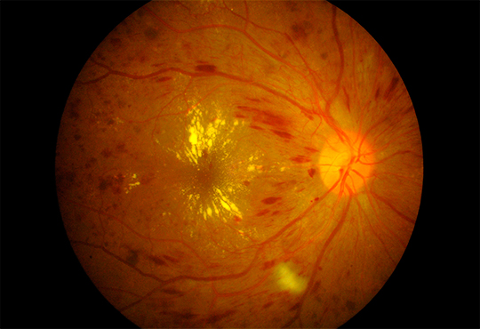 edema macular